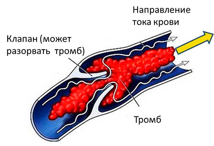 Закупорка вен