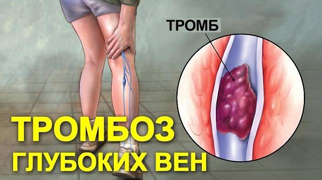 Тромбоз глубоких вен (ТГВ) Тромбоз глубоких вен (ТГВ)