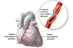 Стенокардия