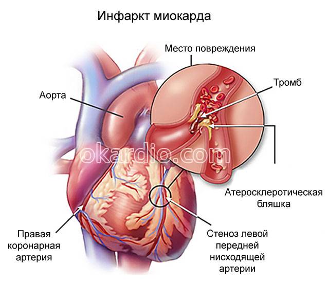 инфаркт миокарда