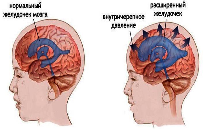 Внутричерепное давление у взрослого Внутричерепное давление