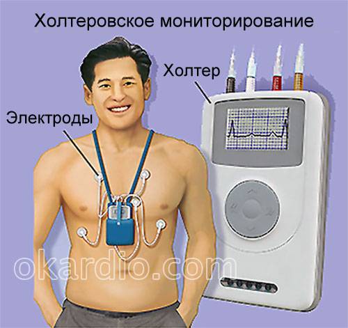 холтеровское мониторирование