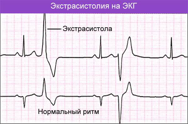 экстрасистола на ЭКГ