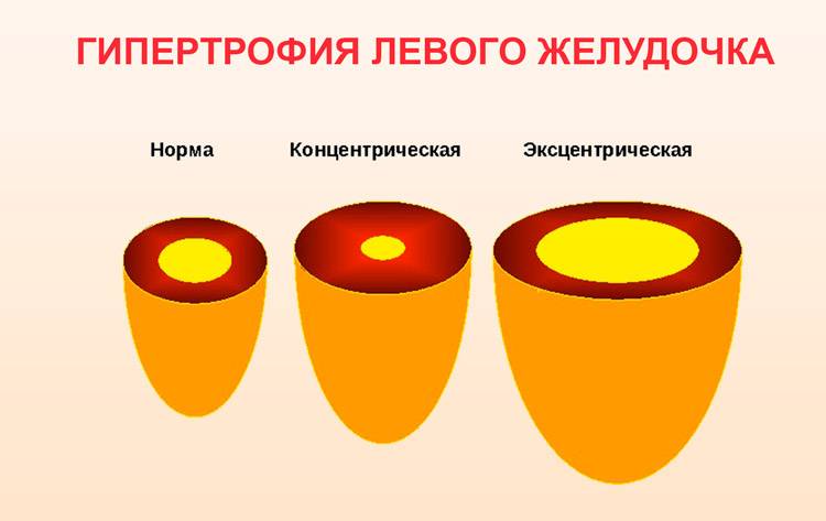 Эксцентрическая гипертрофия