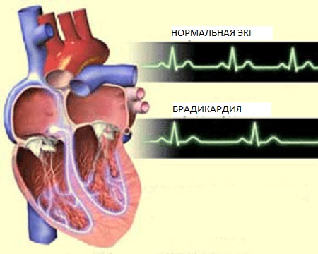 замедленное_сердцебиение
