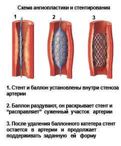 Суть процедуры стентирования