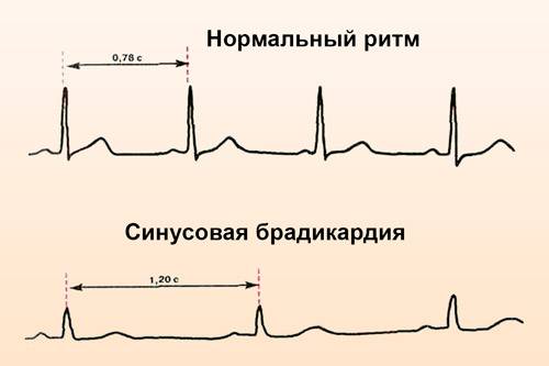 Синусоидальная брадикардия
