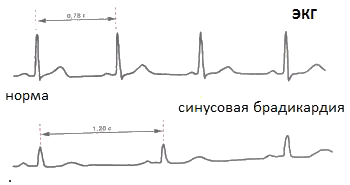 Рис. 2 - Брадикардия на ЭКГ
