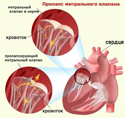 пролапс митрального клапана схема