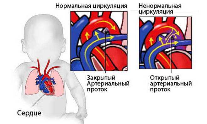 Врожденный порок сердца