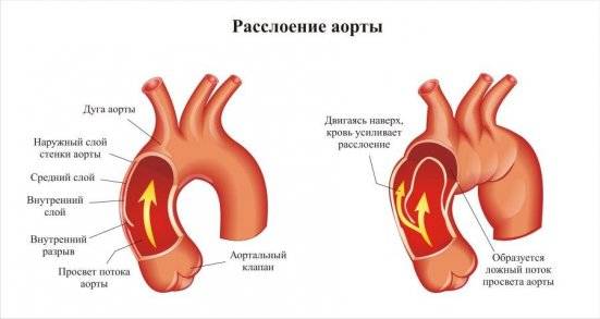 расслоение в артериях