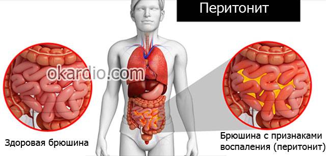 перитонит