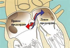 Открытое овальное окно в сердце
