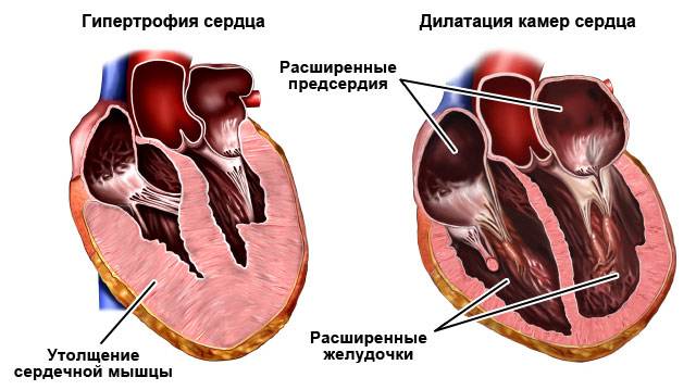 гипертрофия и дилатация камер сердца