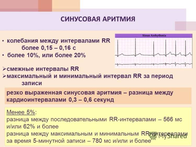 Аритмия на кардиограмме с пояснениями
