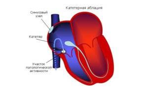 катетерная абляция