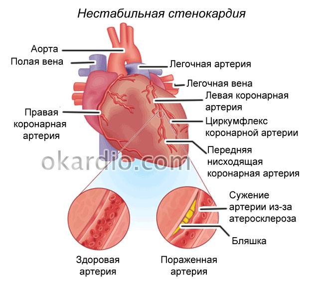нестабильная стенокардия