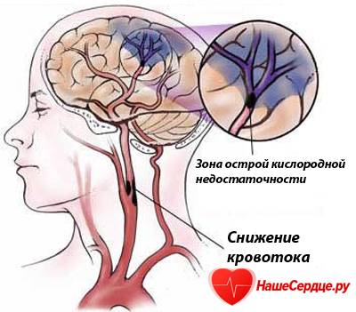 ишемический инсульт