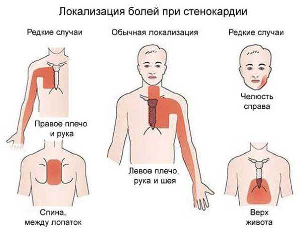 Стенокардия
