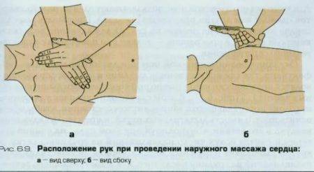 Как правильно делать непрямой массаж сердца
