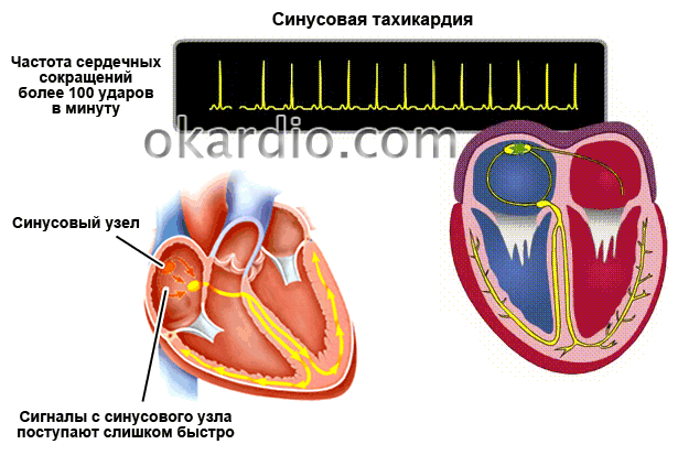 синусовая тахикардия