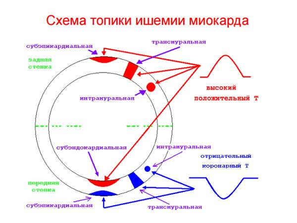 Схема топики ишемии миокарда