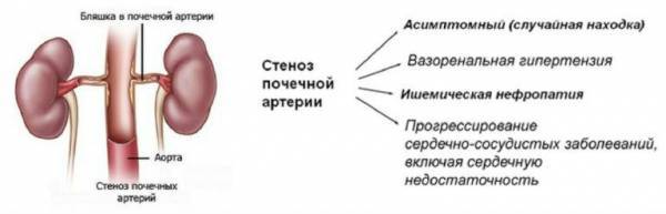 Стеноз почечной артерии