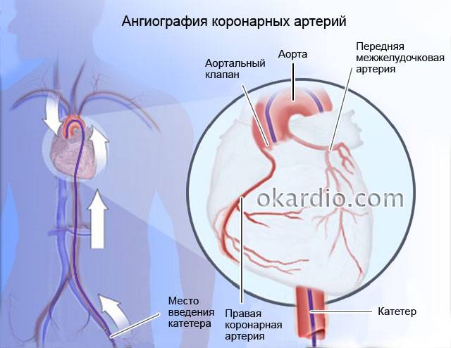 ангиография коронарных артерий