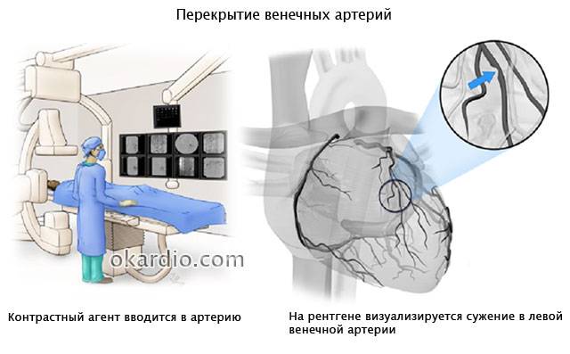 перекрытие венечных артерий