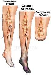 Стадии Облитерирующего атеросклероза артерий нижних конечностей