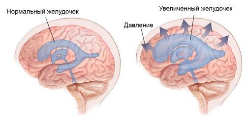 Внутричерепная гипертензия