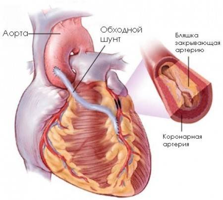 Шунтирование сердца