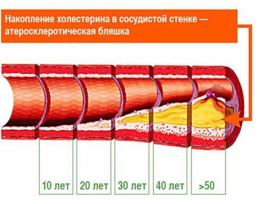 бляшка в сосудах