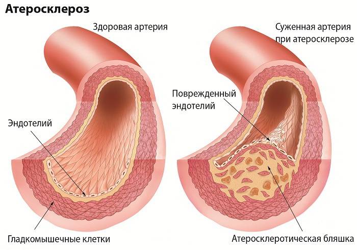 Развитие атеросклероза