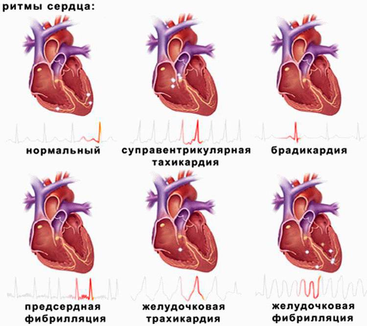 Виды сердечных ритмов