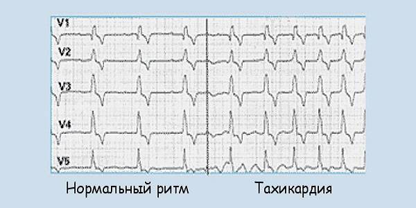 Тахикардия на ЭКГ