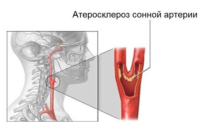 Атеросклероз
