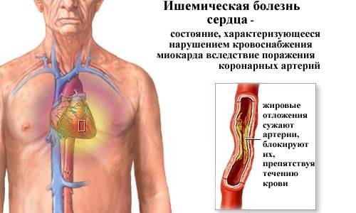Проблема ИБС