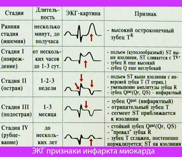 ЭКГ признаки инфаркта миокарда