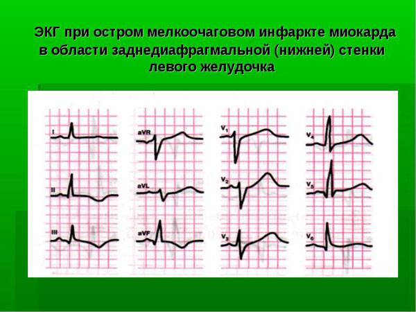 ЭКГ при остром мелкоочаговом инфаркте миокарда