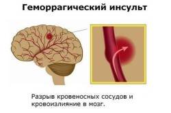 Схема инсульта геморрагического типа