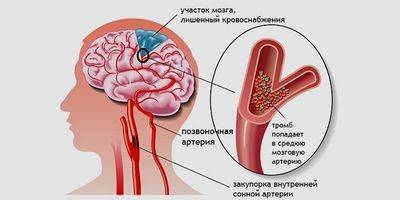 Народное лечение ишемия головного мозга