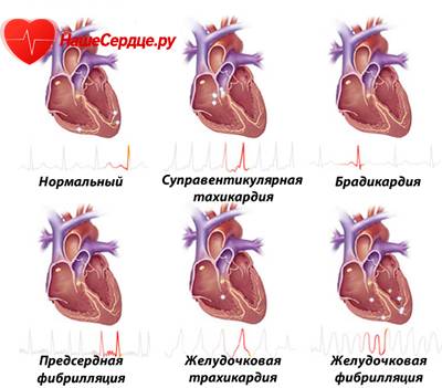 Аритмия виды