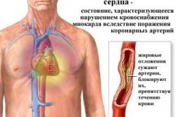 ИБС - причина блокады пучка Гиса