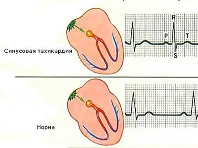 Синусовая тахикардия