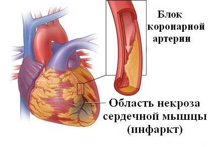 Инфаркт миокарда