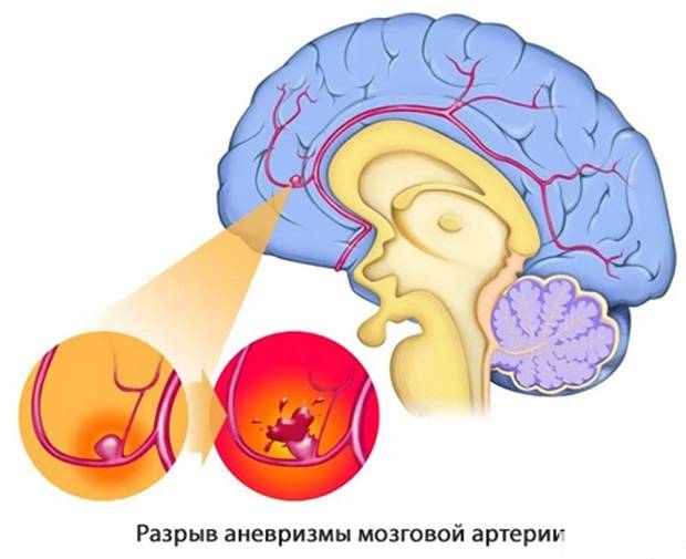 Разрыв