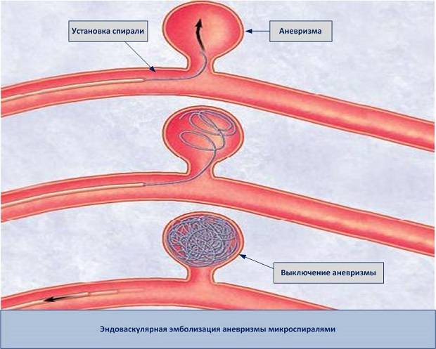 Эндоваскулярная эмболизация