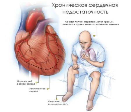 Симптомы сердечной недостаточности