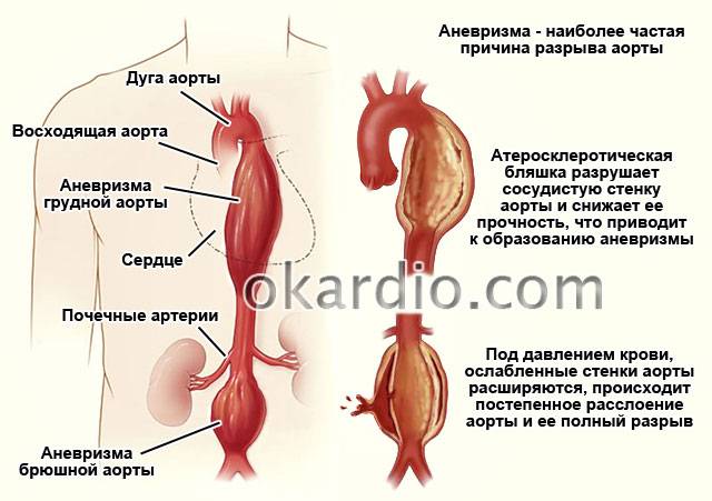 аневризма – причина разрыва аорты